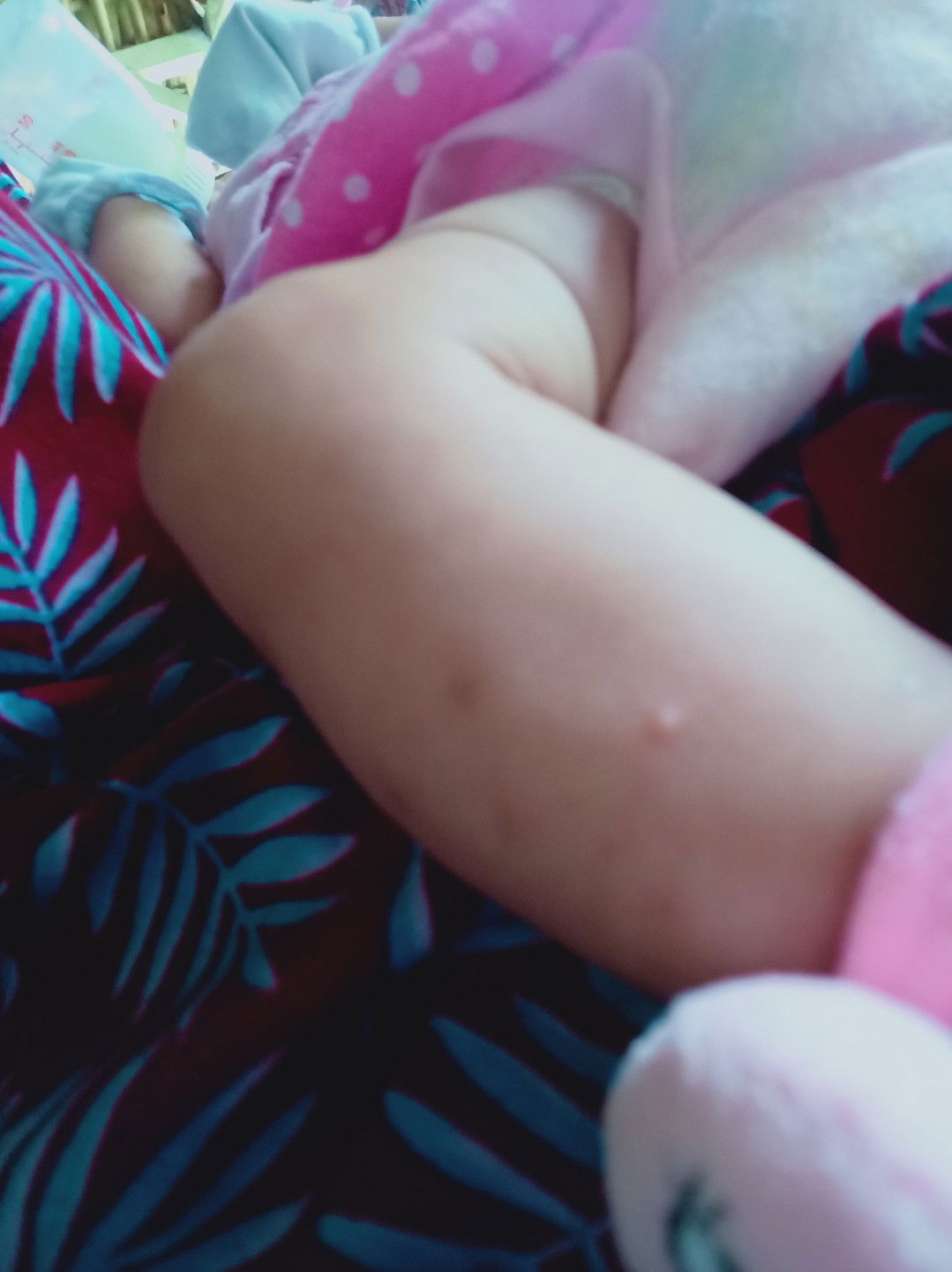 bekas gigitan nyamuk