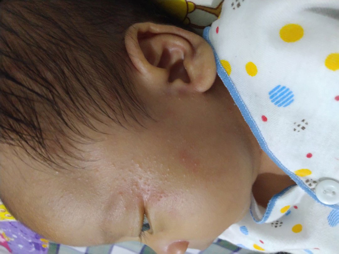 Biang keringat atau Alergi?