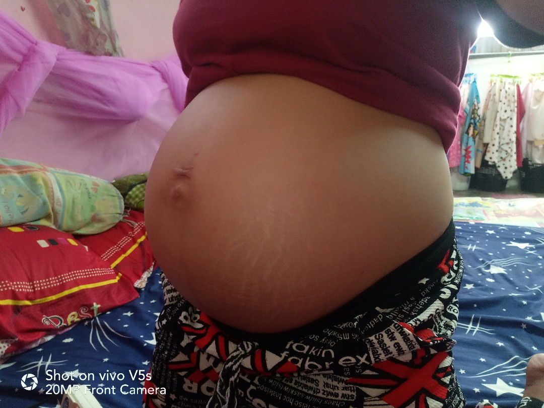 ตั้งครรภ์  34+4d  ท้องแข็ง จิ๊ดๆที่จิมิ