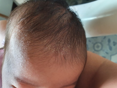 มีลูกๆบ้านไหนเป็บแบบนี้บ้างไหมคะแล้วมีวิธีการรักษาแบบไหนบ้างคะ