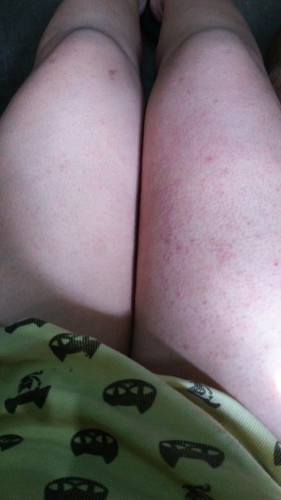 ALLERGY MGA MOMSH HELP