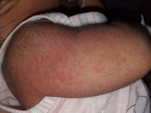 Skin allergy????