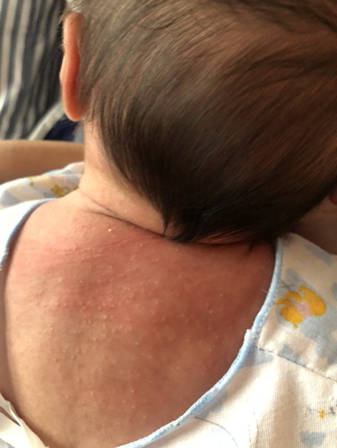 ผื่นแบบนี้น้องแพ้อะไรหรือเปล่าค่ะ