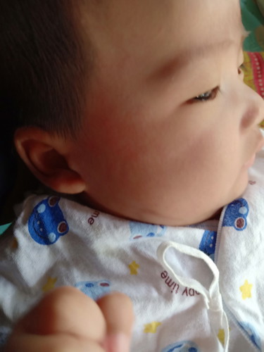 สอบถามคะ แม่บ้านไหนลูกเป็นผื่นขึ้นหน้าแบบนี้บางค่ะ