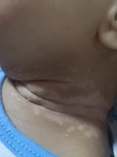 Rashes