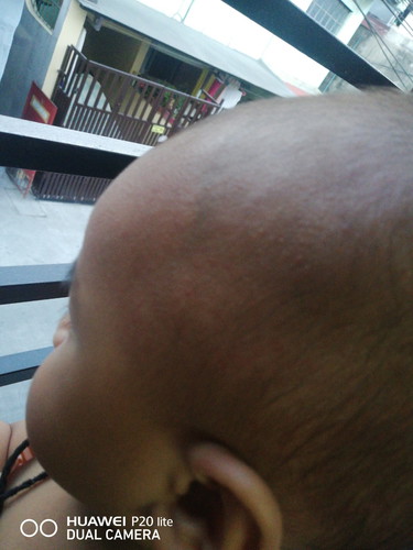Rashes ???