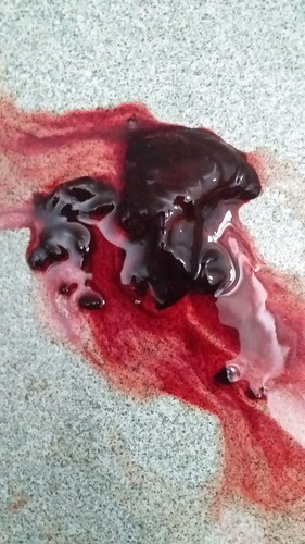 ท้อง 10 w ปวดท้องลิ้มเลือดไหลออกแบบนี้แท้งไหมค่ะ