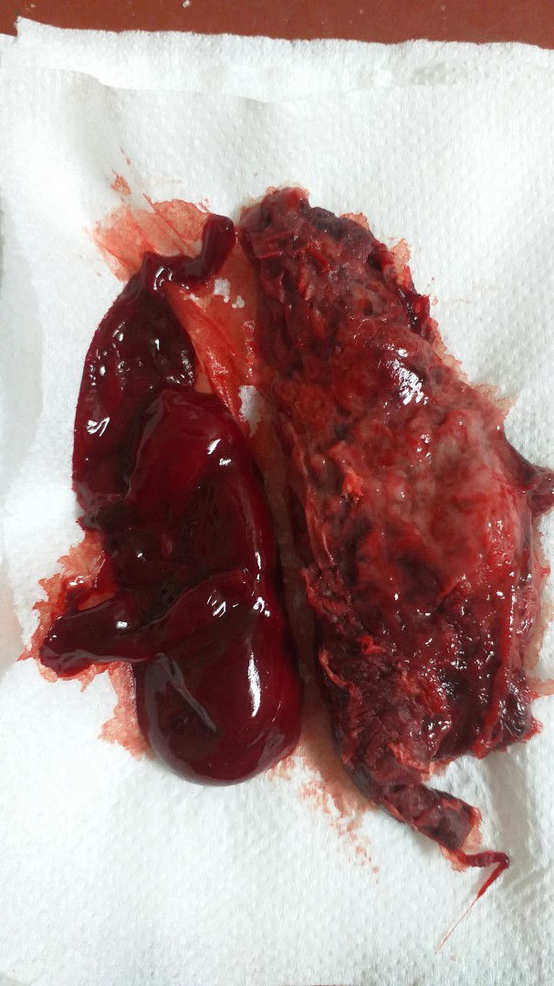 จากของขวัญ..กลายเปน(แท้ง)ความเศร้าที่แสนเจ็บปวด