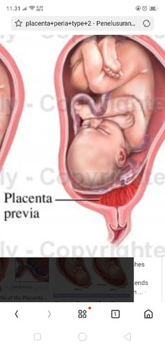 plasenta previa type II
