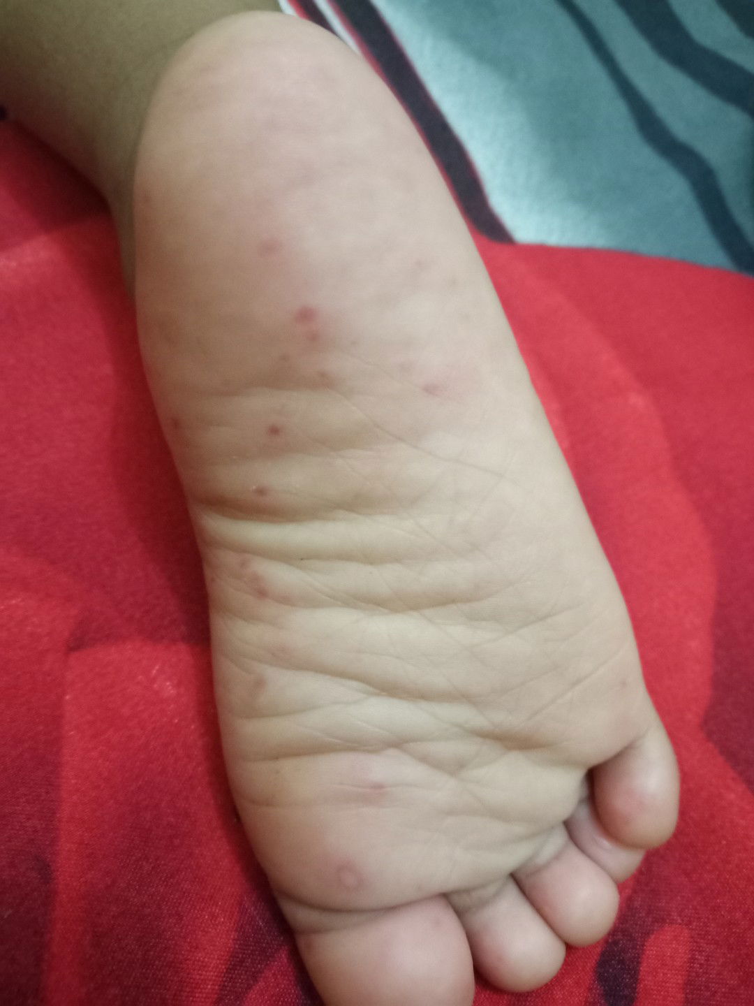 Bintik Merah dikaki Bayi