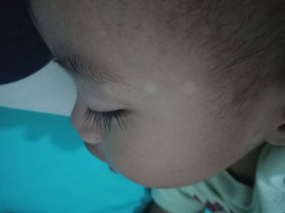 bercak putih pada bayi