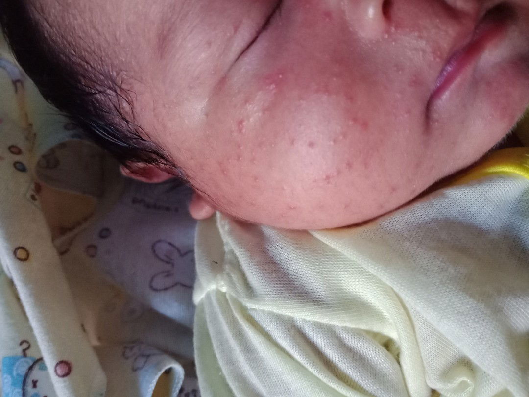 bintik merah di pipi bayi