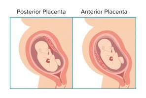 anterior placenta