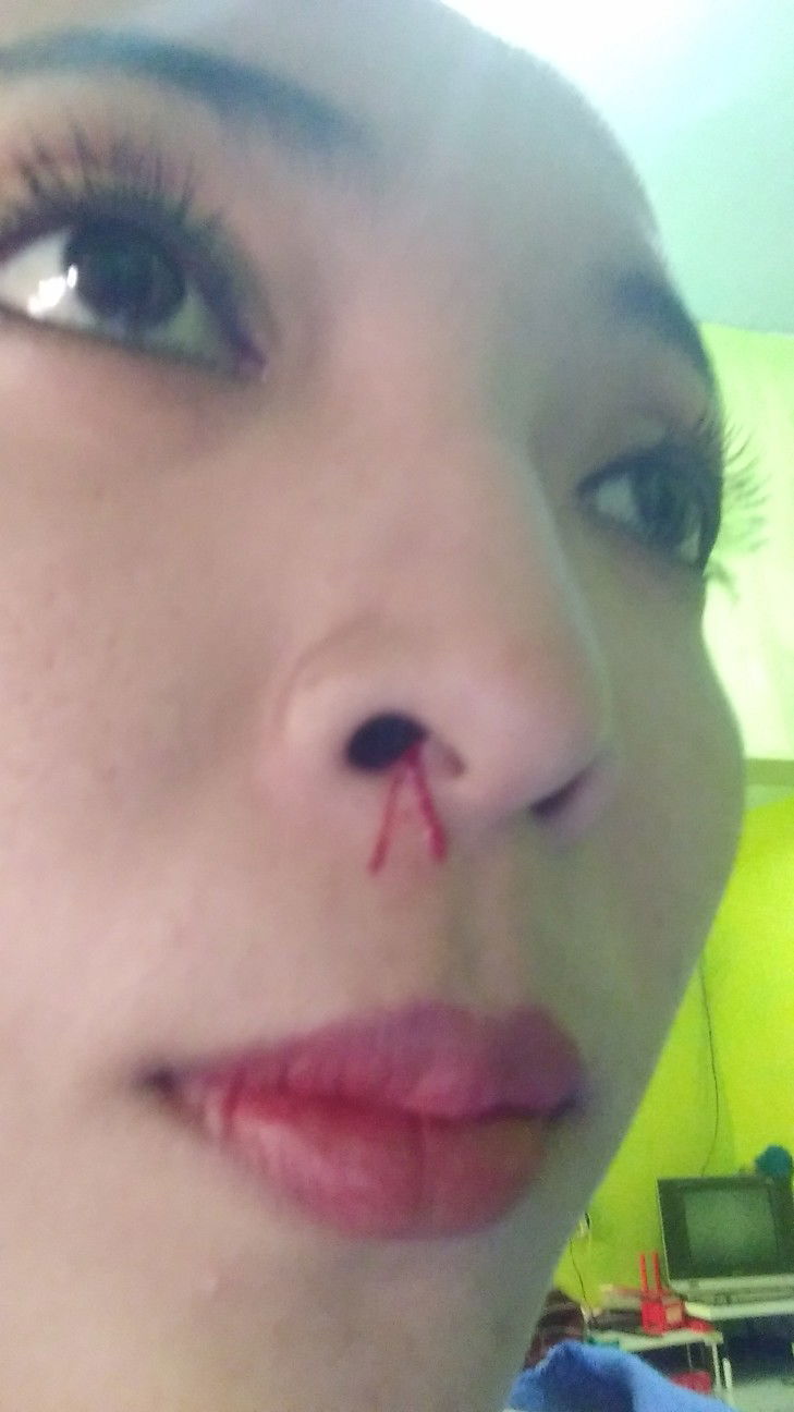 hidung kering/berdarah