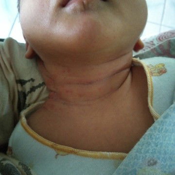 kulit bayi mengelupas dan biang keringant