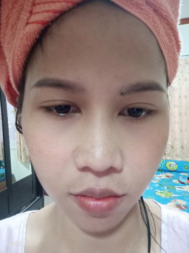 ฝ้าขณะตั้งครรภ์