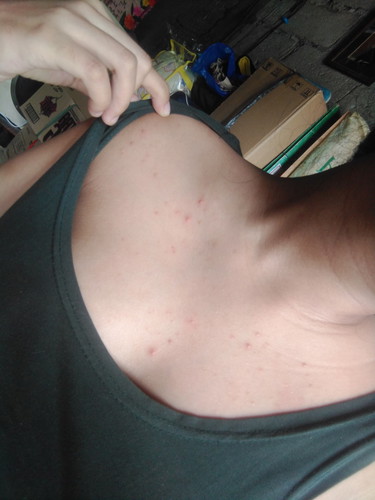 rashes at pimples???