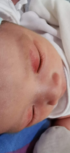 Red Birthmark