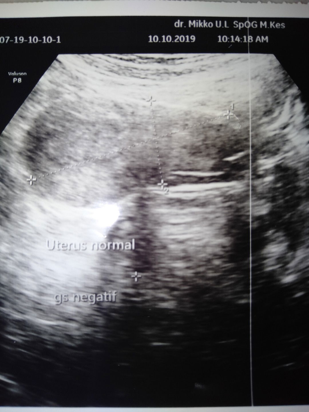 gumpalan darah. yg ada tanda garis dan+itu