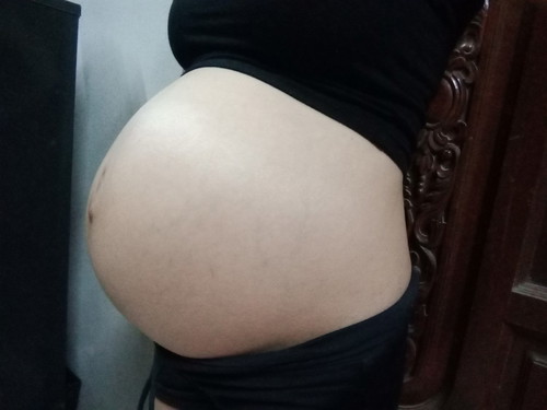 คลอดแล้วท้องลาย