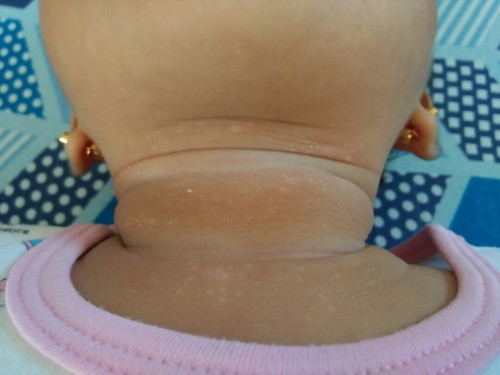 skin asthma?