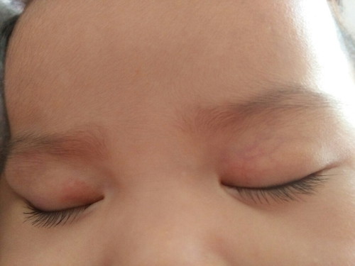 hemangioma