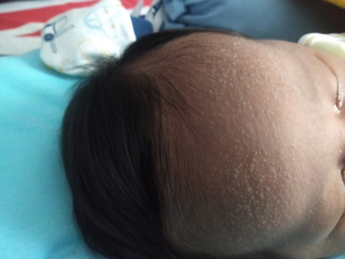 Beruntusan Pada Bayi Newborn