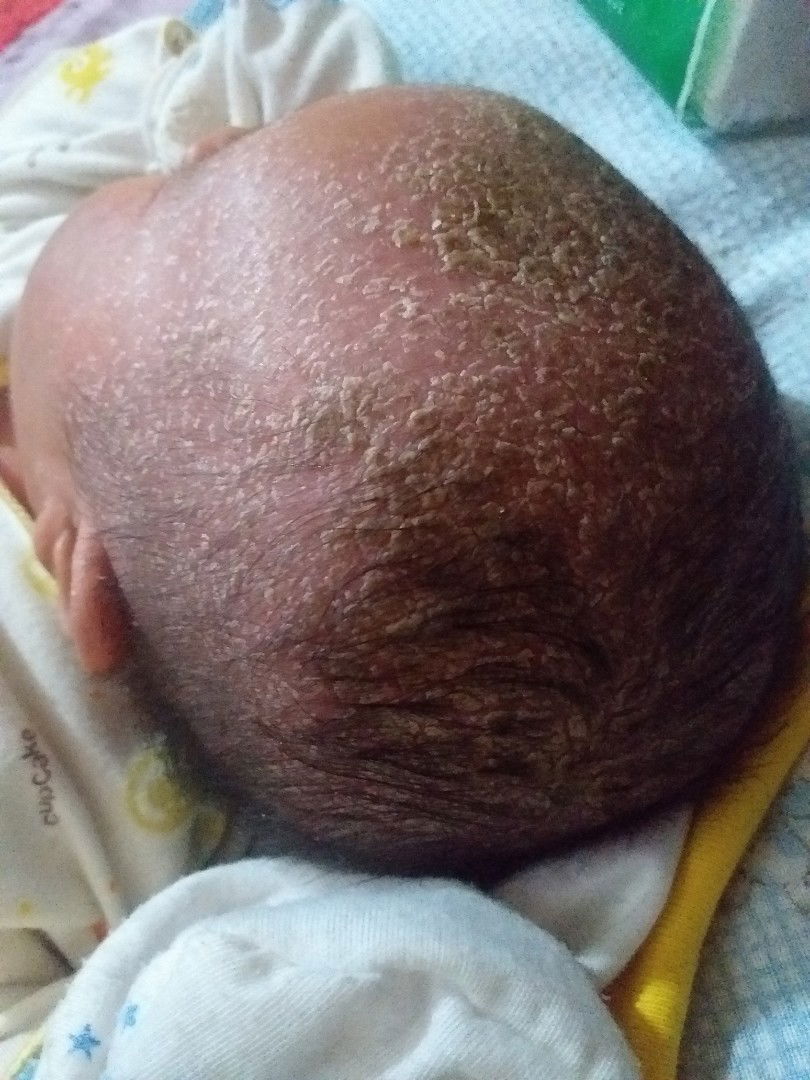 ruam pada kepala bayi