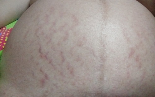 แม่ๆคนไหนที่ท้องเป็นแบบนี้บ้างคะ