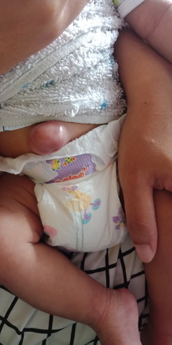 สะดือโป่ง