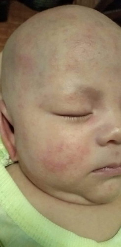 น้องเป็นผื่น