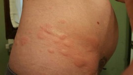 POSPARTUM RASH