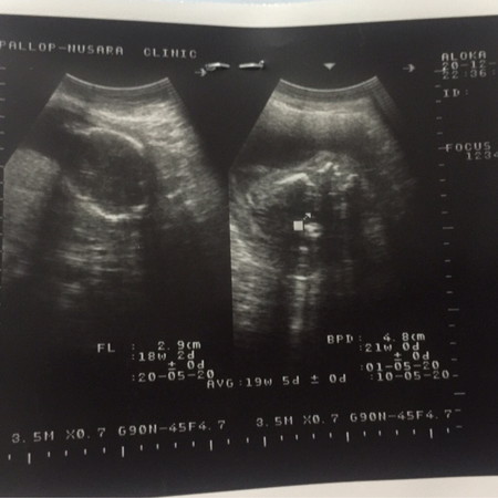 20 week แล้ว