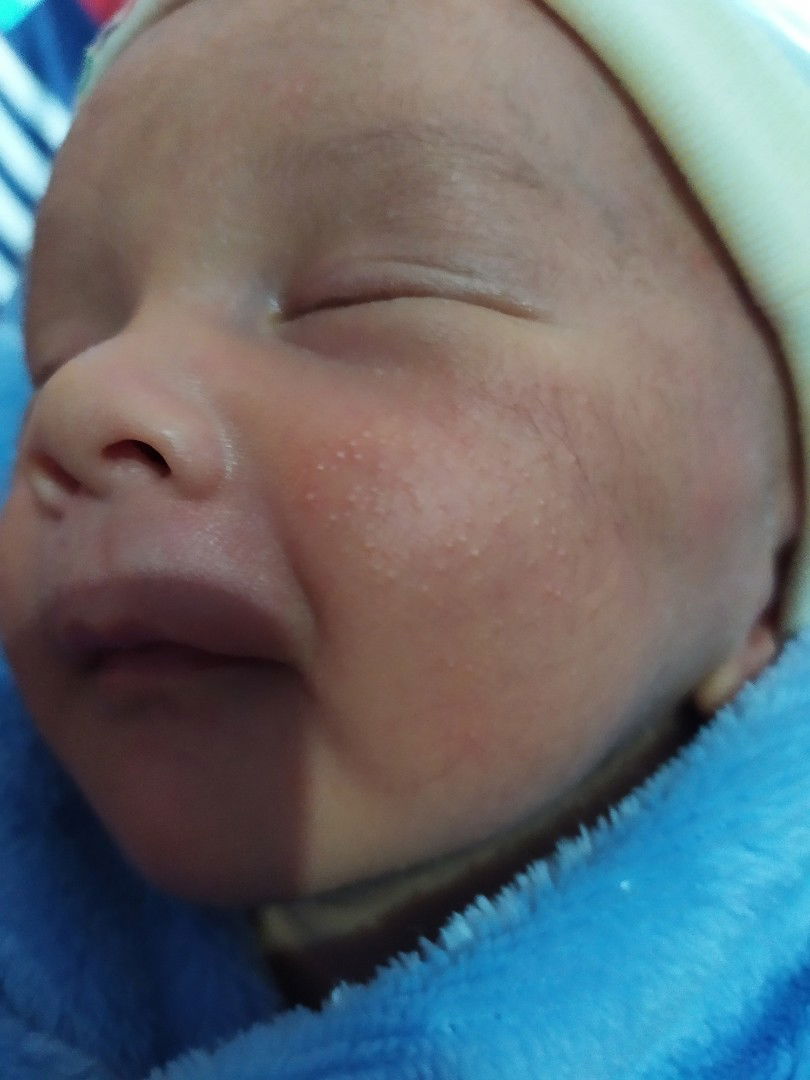 bruntusan karna Asi katanya