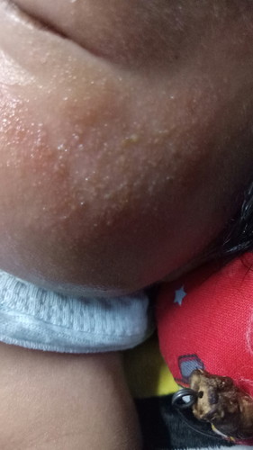 BINTIK MERAH PADA BAYI