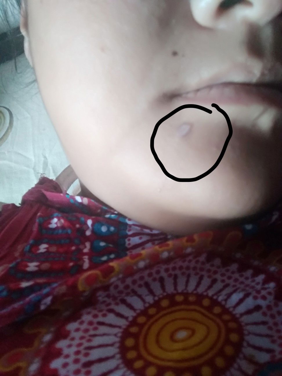 Menghilangkan bekas jerawat