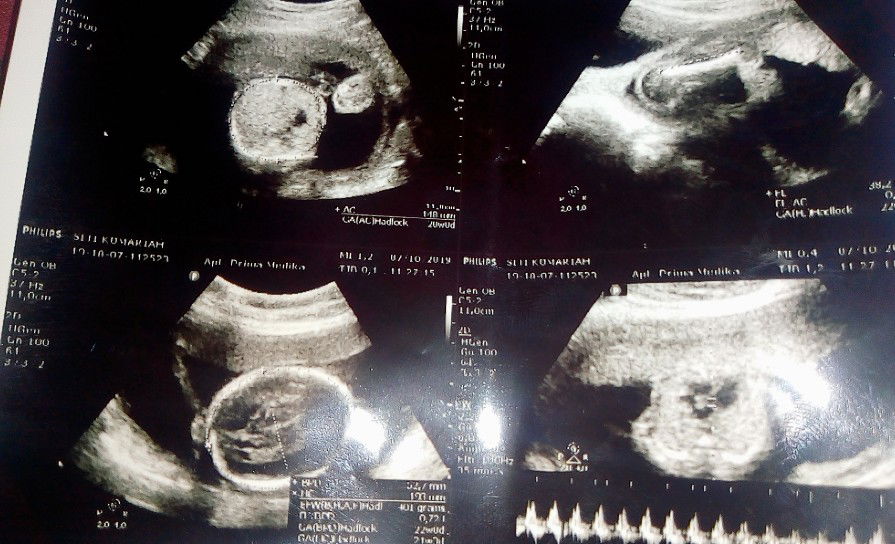 alhamdulilah baby girl,,