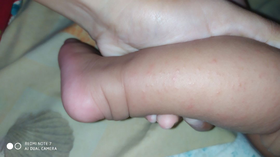 bintik di kaki