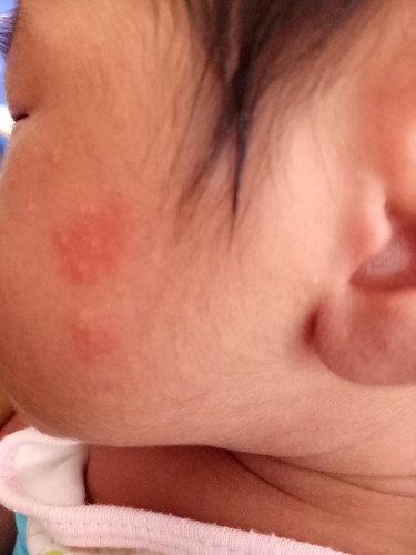 Rashes
