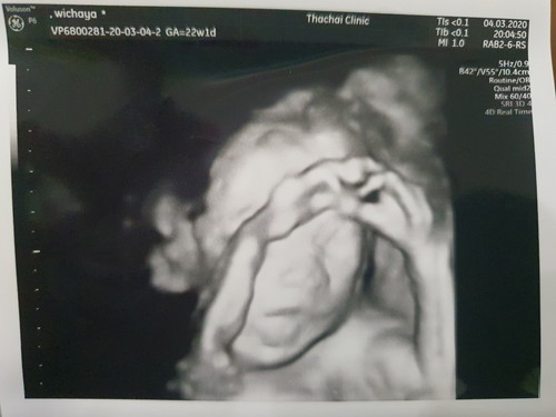 ซาว 4 D 22 weeks