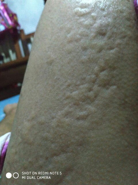 Gatal Sampai Bentol2