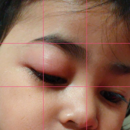 Swollen eyes