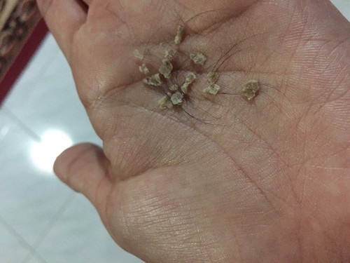 Kerak dikepala bayi