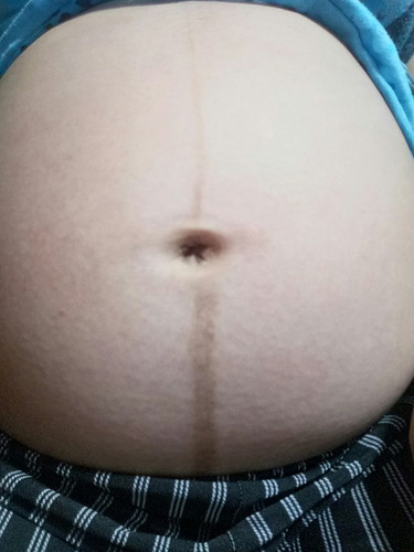 LINEA NIGRA ( PREDICTION GENDER)