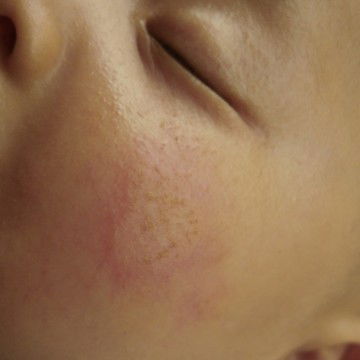 bintik merah di wajah