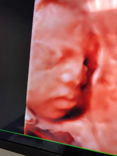 28weeks แล้วนะลูกสาวแม่ทำไมรู้สึกนานเหลือเกิน?อยากเห็นหน้าแล้ว