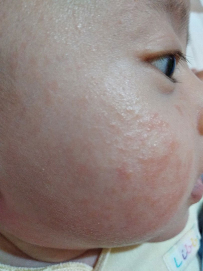 ruam merah dan gatal