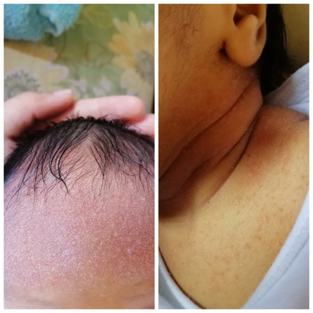 New Born Baby Skin Problem
