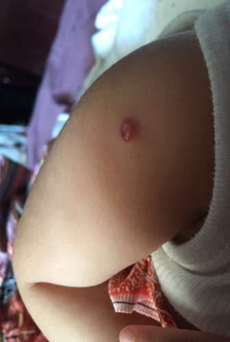 Bekas imunisasi