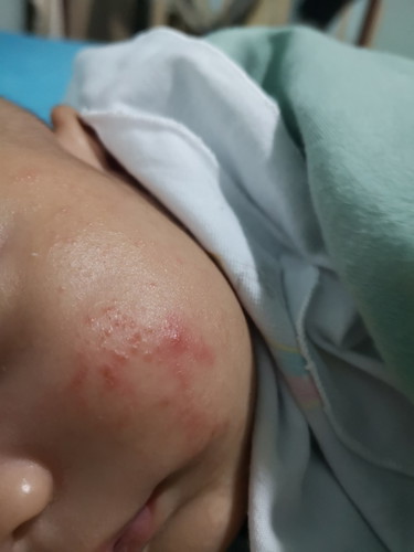 Ruam Susu Ke Apa